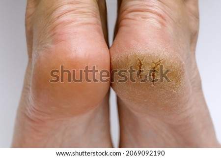 Cracked heels before and after treatment and treatment. Medical pedicure in a beauty salon. Problematic dehydrated feet with dry skin. Close-up photo of legs.  Royalty-Free Stock Photo #2069092190