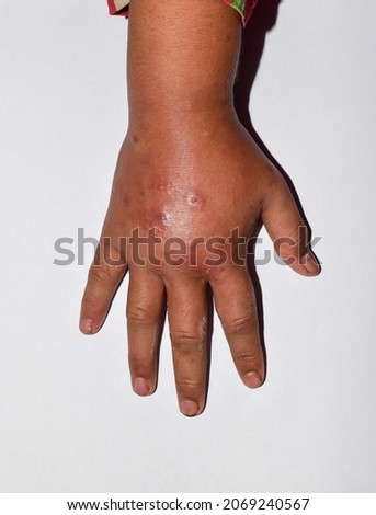 Unilateral edema with scabies of upper limb. Swollen hand and arm of Asian child. Royalty-Free Stock Photo #2069240567