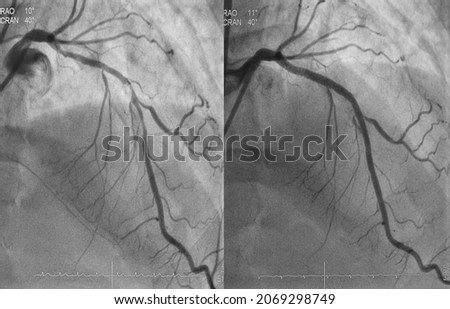 Comparison of pre-post percutaneous coronary intervention (PCI) at proximal to mid left anterior descending artery (LAD) with drug eluting stent (DES).  Royalty-Free Stock Photo #2069298749