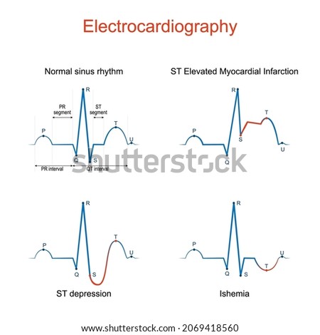 ST-SEGMENT-ELEVATION Stock Vector Images - Avopix.com