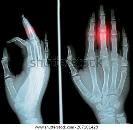 film x-ray hand AP and lateral