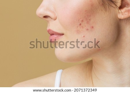 A young woman with bad skin. Skin with a lot of pimples. Acne disease, acne treatment. Royalty-Free Stock Photo #2071372349