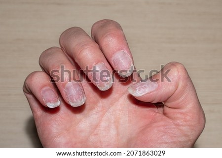 Flaky bitten and brittle nails without a manicure. Regrown nail cuticle and damaged nail plate after gel polish. Royalty-Free Stock Photo #2071863029