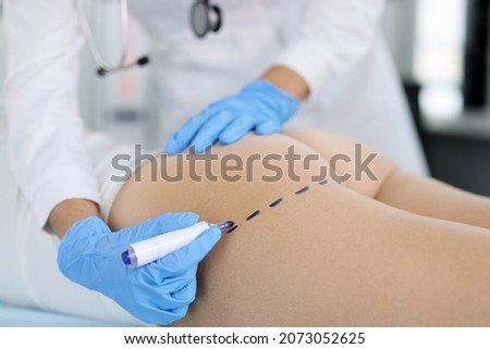 Doctor draws marks on the patient's buttocks with marker for body shaping Royalty-Free Stock Photo #2073052625