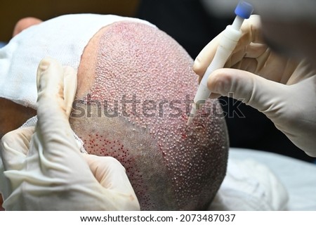 hair transplantation with dhi technique
 Royalty-Free Stock Photo #2073487037
