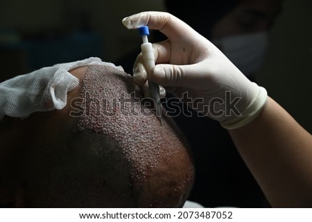 hair transplantation with dhi technique
 Royalty-Free Stock Photo #2073487052