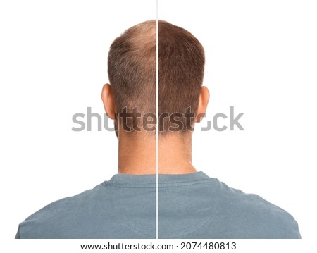 Man with hair loss problem before and after treatment on white background, collage. Visiting trichologist Royalty-Free Stock Photo #2074480813