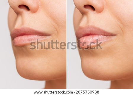 Cropped shot of young women's face with lips before and after lip enhancement on a gray background. Injection of filler in lips. Lip augmentation
