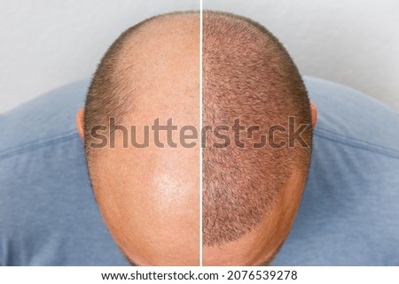 The head of a balding man before and after hair transplant surgery. A man losing his hair has become shaggy. An advertising poster for a hair transplant clinic. Treatment of baldness. Royalty-Free Stock Photo #2076539278