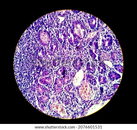 Colon Cancer. Photomicrograph (microscopic image) of colonic adenocarcinoma,Light microscope 100x showing colon adenocarcinoma Royalty-Free Stock Photo #2076601531