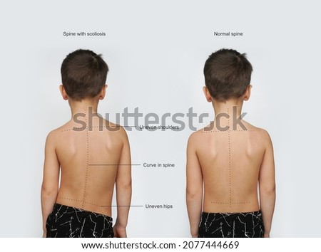 Signs Of Scoliosis. Normal healthy spine and curved spine with scoliosis.Scoliosis in children Royalty-Free Stock Photo #2077444669
