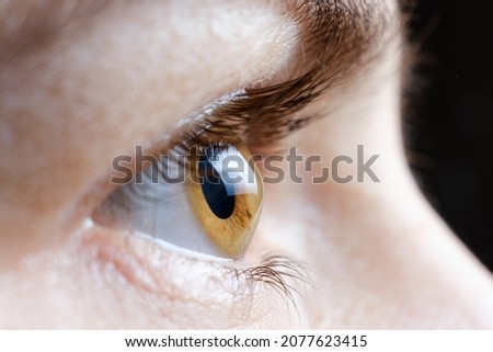Macro photo of the human eye with corneal disease keratoconus Royalty-Free Stock Photo #2077623415