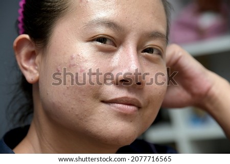 Portrait of Asian woman pointing nace problem occur on her face. Conceptual of problems on woman skin. An Asian woman has acne on her face but she smiles without worrying too much about it. Royalty-Free Stock Photo #2077716565