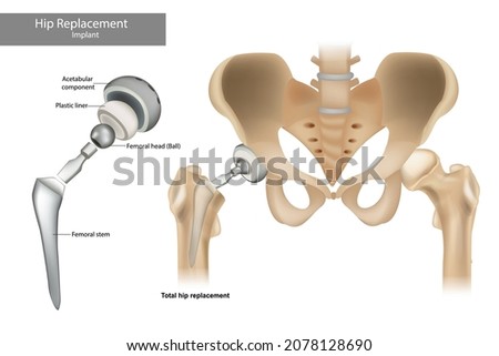 Total hip replacement components. Hip Implant. Royalty-Free Stock Photo #2078128690