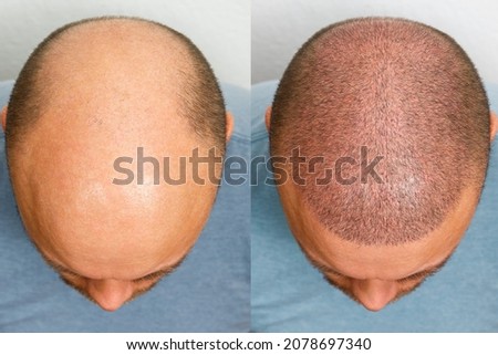 The head of a balding man before and after hair transplant surgery. A man losing his hair has become shaggy. An advertising poster for a hair transplant clinic. Treatment of baldness. Royalty-Free Stock Photo #2078697340