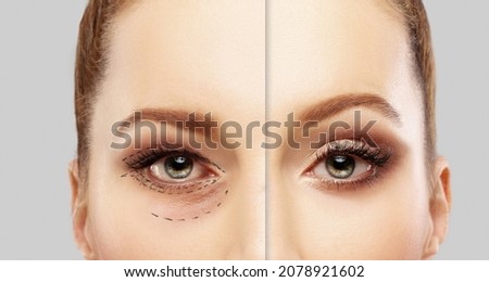 Lower and upper Blepharoplasty.Marking the face.Perforation lines on females face, plastic surgery concept. Royalty-Free Stock Photo #2078921602