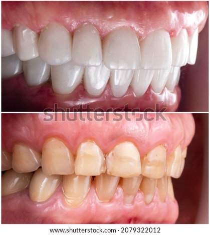 teeth indirect restoration and making new smile by ceramic veneers b1 color