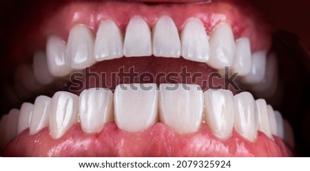 teeth indirect restorations by ceramic crowns and veneers