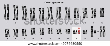 Human karyotype of Down syndrome. Autosomal abnormalities. Trisomy 21. Genetic disorder.  Royalty-Free Stock Photo #2079480550