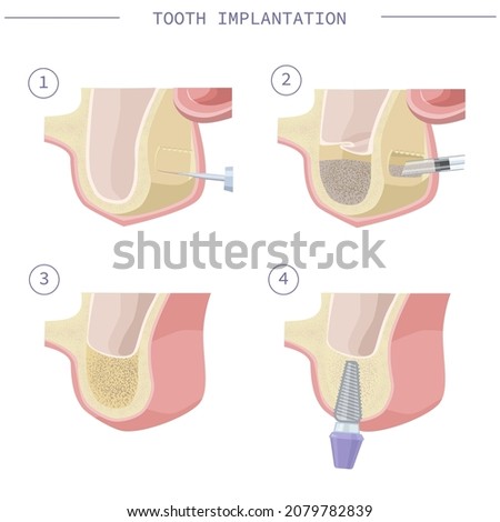 Dental treatment. Open sinus lift. Dental services. Vector illustration for dental textbooks. Step-by-step instruction Royalty-Free Stock Photo #2079782839