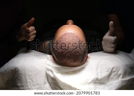 Hair transplant patient in the end of the operation Royalty-Free Stock Photo #2079901783