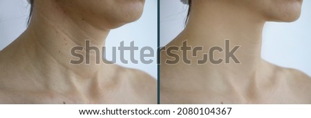 woman neck wrinkles before and after Royalty-Free Stock Photo #2080104367