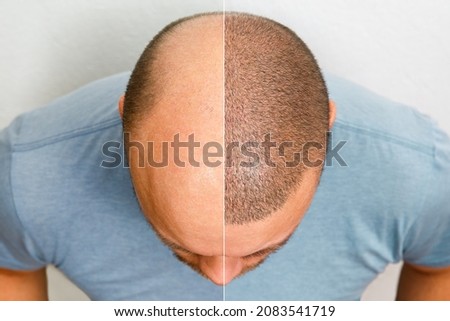 The head of a balding man before and after hair transplant surgery. A man losing his hair has become shaggy. An advertising poster for a hair transplant clinic. Treatment of baldness. Royalty-Free Stock Photo #2083541719