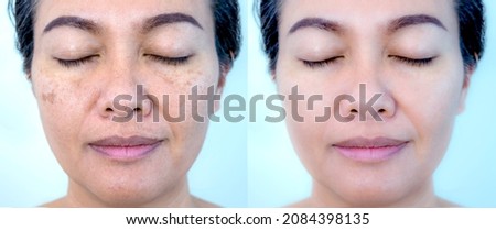Retouched image before and after spot melasma pigmentation facial treatment on middle age asian woman face. Skincare and health problem concept.  Royalty-Free Stock Photo #2084398135