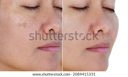 Image before and after spot melasma pigmentation facial treatment on middle age asian woman face. skincare and health problem concept.  Royalty-Free Stock Photo #2084415331