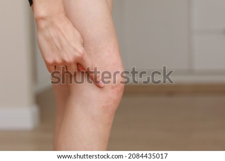 skin allergies, legs skin women. Closeup of red pustules on a knee, an allergic reaction caused by atopic dermatitis. Selected focus. Royalty-Free Stock Photo #2084435017