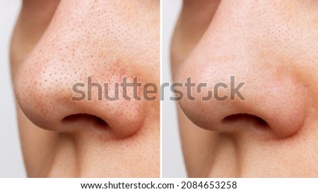 Close-up of woman's nose with blackheads or black dots before and after peeling and cleansing the face isolated on a white background. Acne problem, comedones. Cosmetology dermatology concept Royalty-Free Stock Photo #2084653258