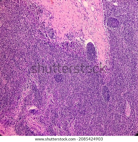 Lymph angioma, Photomicrograph of lymphangioma(cystic hygroma) or lymphatic malformation, benign lesions,  noncancerous, fluid-filled cysts that occur in lymphatic vessels. Royalty-Free Stock Photo #2085424903