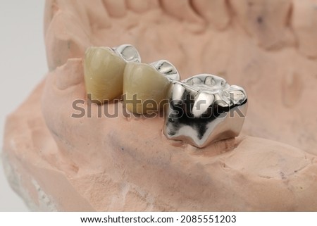 Porcelain fused to metal crown Royalty-Free Stock Photo #2085551203