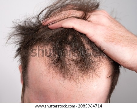 Close up of a young man holding his hair back showing clear signs of a receding hairline and hair loss. Concept showing the first stages of male pattern baldness with bald patches and thinning hair. Royalty-Free Stock Photo #2085964714