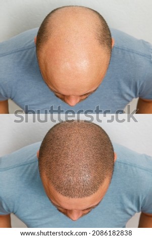 The head of a balding man before and after hair transplant surgery. A man losing his hair has become shaggy. An advertising poster for a hair transplant clinic. Treatment of baldness. Royalty-Free Stock Photo #2086182838