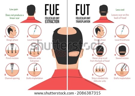 FUT and FUE hair transplantation process vector isolated. Follicular unit extraction or transplantation. Baldness problem, surgical treatment. Graft implantation, medical infographic. Royalty-Free Stock Photo #2086387315