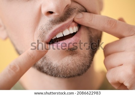 Man with gum inflammation, closeup Royalty-Free Stock Photo #2086622983