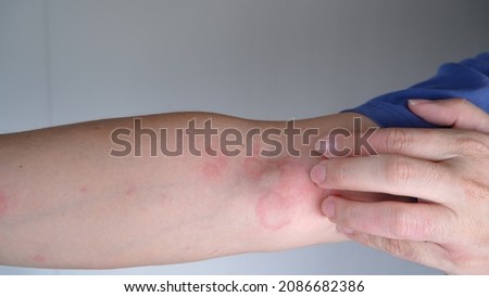 Close up image of skin texture suffering severe urticaria or hives or kaligata on arm. Allergy symptoms. Royalty-Free Stock Photo #2086682386