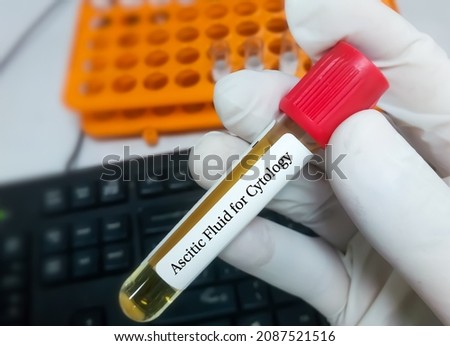 Oncologist hold Ascitic fluid sample for cytological test. Peritoneal cavity fluid. Oncology. Royalty-Free Stock Photo #2087521516