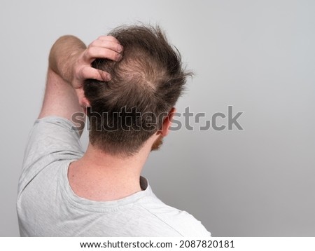 Behind view of a young balding man's head showing clear signs of balding and hair loss around the scalp. Male pattern baldness concept against a clear white background with room for text. Royalty-Free Stock Photo #2087820181