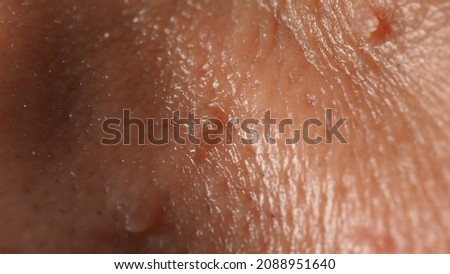 Wart on face. Macro shot of wart near eye. Papilloma on skin around eye nose and neck. Close up of birthmark Papilla or mole on skin. small hard. benign growth on the skin. caused by virus. skincare.