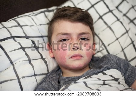 a boy of European appearance with the first signs of the virus, red spots on his face. Allergy on the child's face Royalty-Free Stock Photo #2089708033