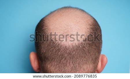 Hair loss in men. Bald head of an adult man from the back. Alopecia on the head. Royalty-Free Stock Photo #2089776835