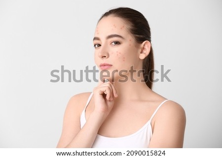 Young woman with acne problem on light background Royalty-Free Stock Photo #2090015824