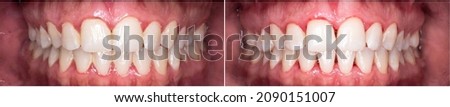 teeth cleaning before and after picture