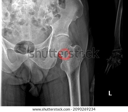 Stress fracture on the femoral neck showed by radiograph,xray view.Compression type of stress fracture. Broken part circled with red. fracture is located on the medial part of left femural neck. Royalty-Free Stock Photo #2090269234