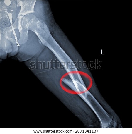 A Femoral shaft fracture of children.
oblique displaced fracture of femur. Terrifiying Fracture of femur due to trauma.Broken thigh. Royalty-Free Stock Photo #2091341137
