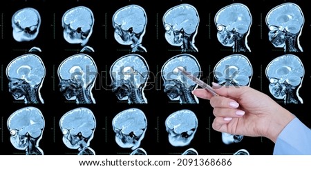 Doctor's hand points to a set of MRI scans of the human skull and brain, with cerebral malformations, preliminary diagnosis, holoproencephaly, absence, agenesis of the transparent septum, side view.  Royalty-Free Stock Photo #2091368686