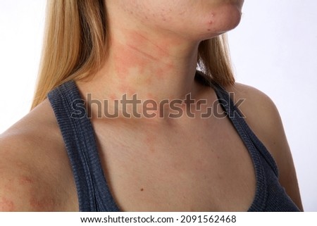 Symptoms of a pulp on the skin of a young woman 