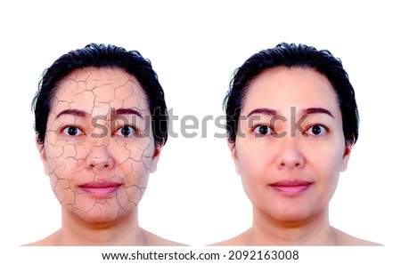 Retouched image before and after skin care treatment on Asian woman face with dry skin texture vs clean healthy skin. Skin care and beauty concept.